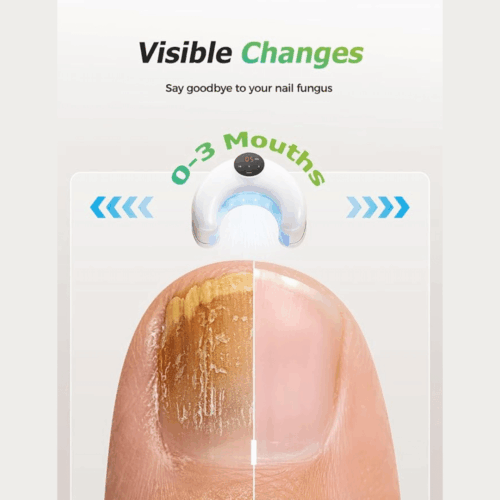 LumoNail (Upgraded Version) - Official Retailer