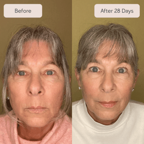 Renewa EyeLift Device (Official Retailer) 2025