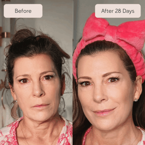 Renewa EyeLift Device (Official Retailer) 2025